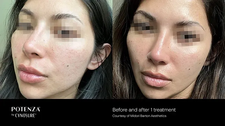 Skincare results before and after treatment.