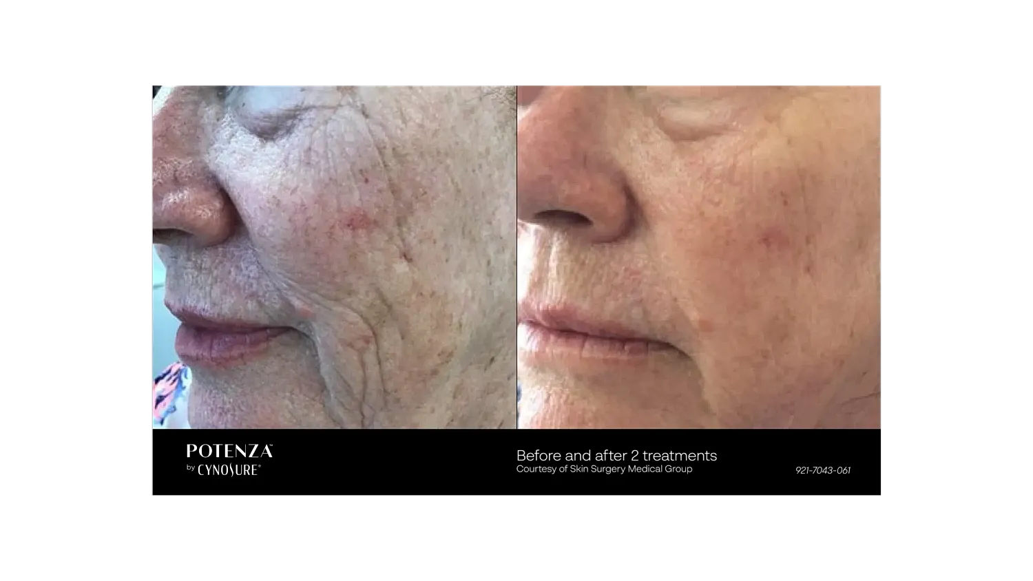 Before and after skin treatment results comparison.