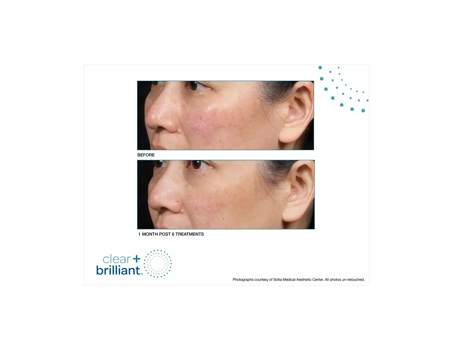 Skin before and after Clear + Brilliant treatment.