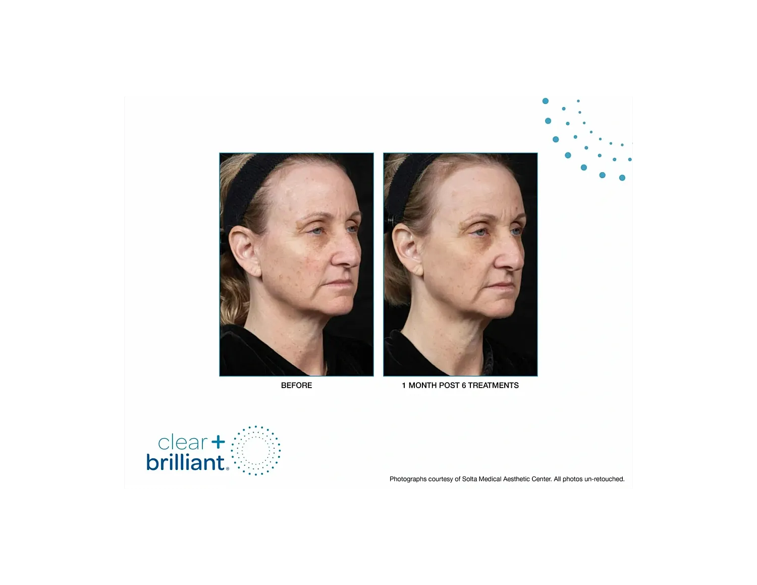 Before and after aesthetic treatment comparison.