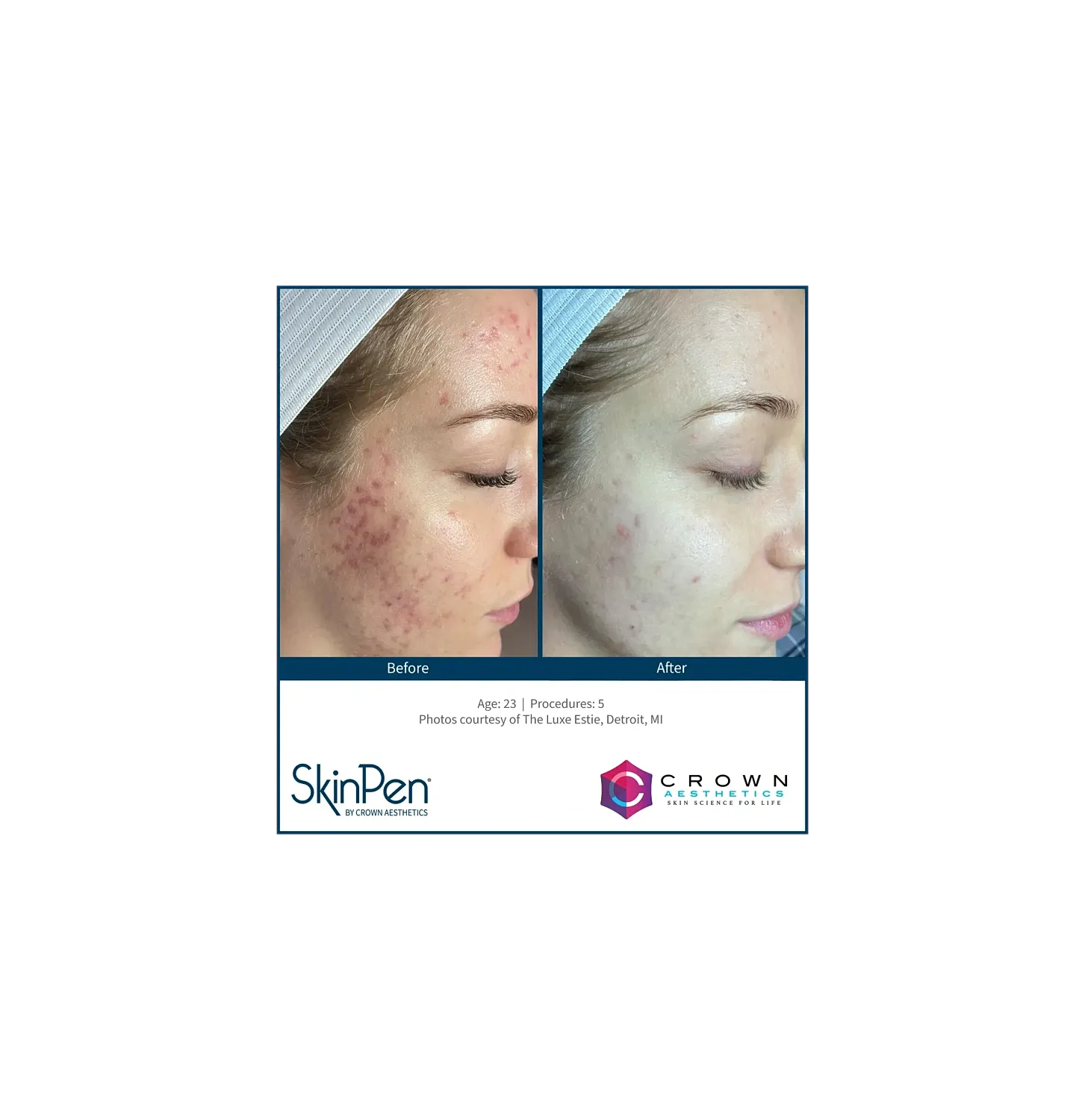 Skin treatment results: before and after comparison.