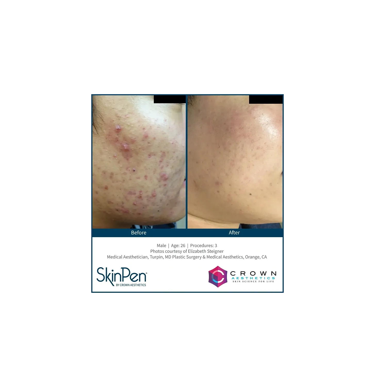 Skin treatment before and after comparison.