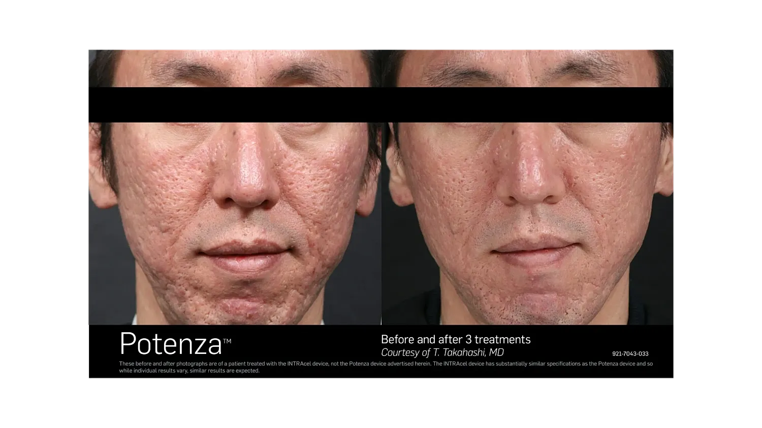 Before and after skin treatment comparison.