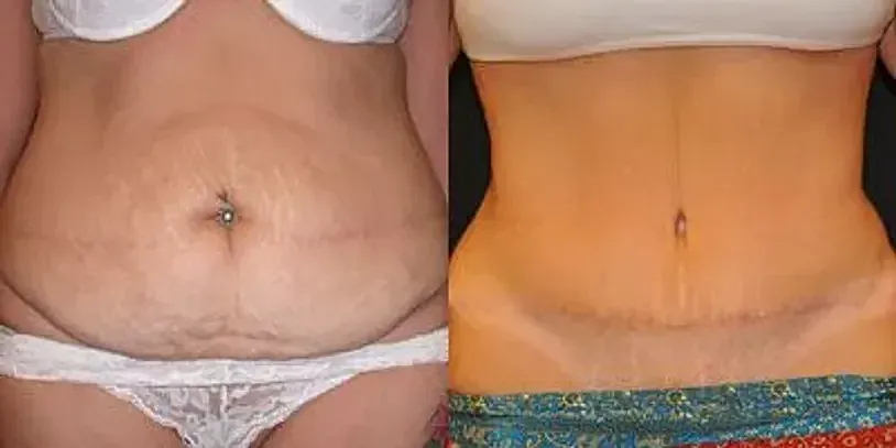 Tummy Tuck Hawaii, Hawaii’s Best Plastic Surgeon, Tummy Tuck Honolulu, Plastic Surgery Honolulu