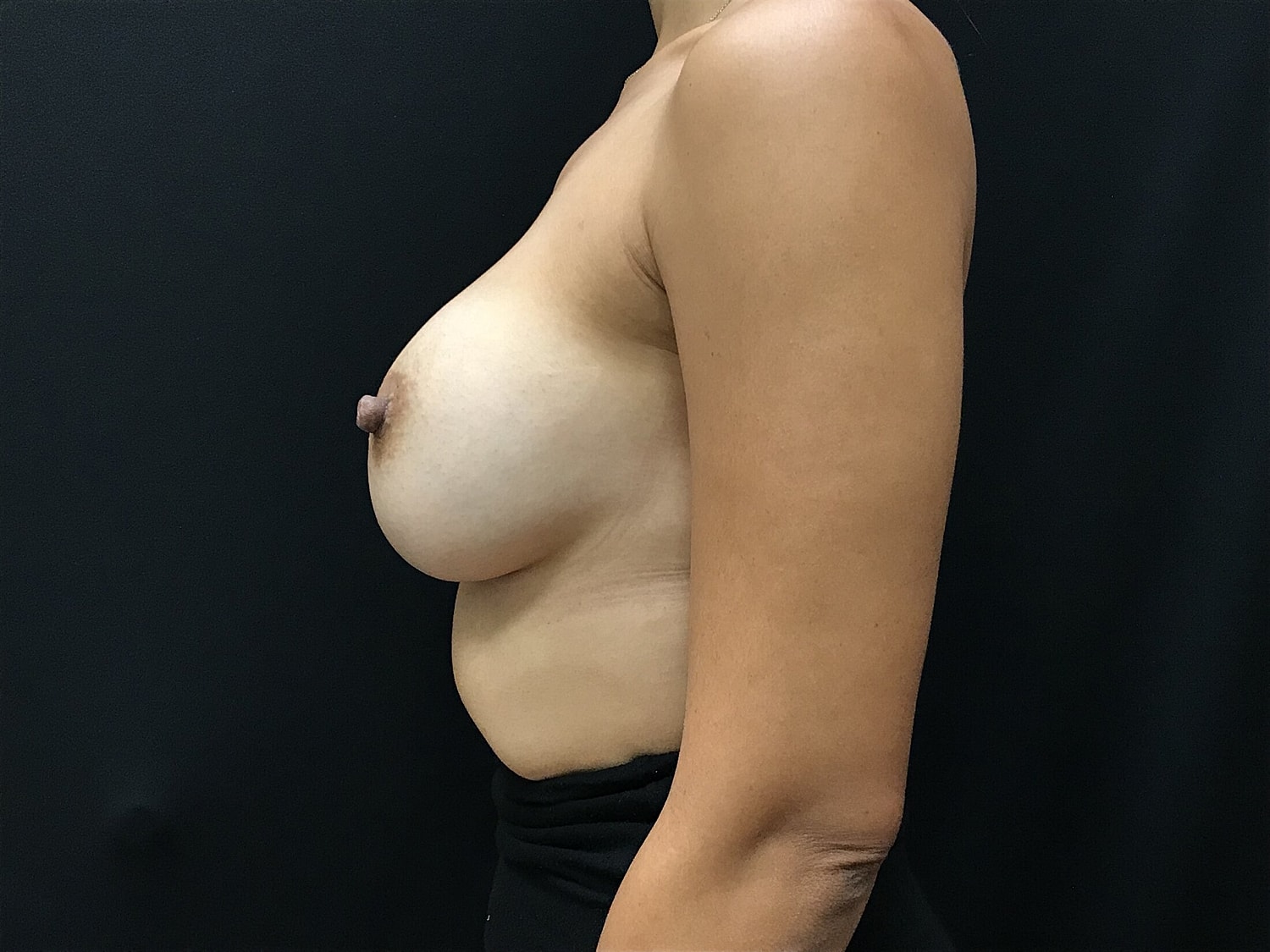 Breast Augmentation Before & After