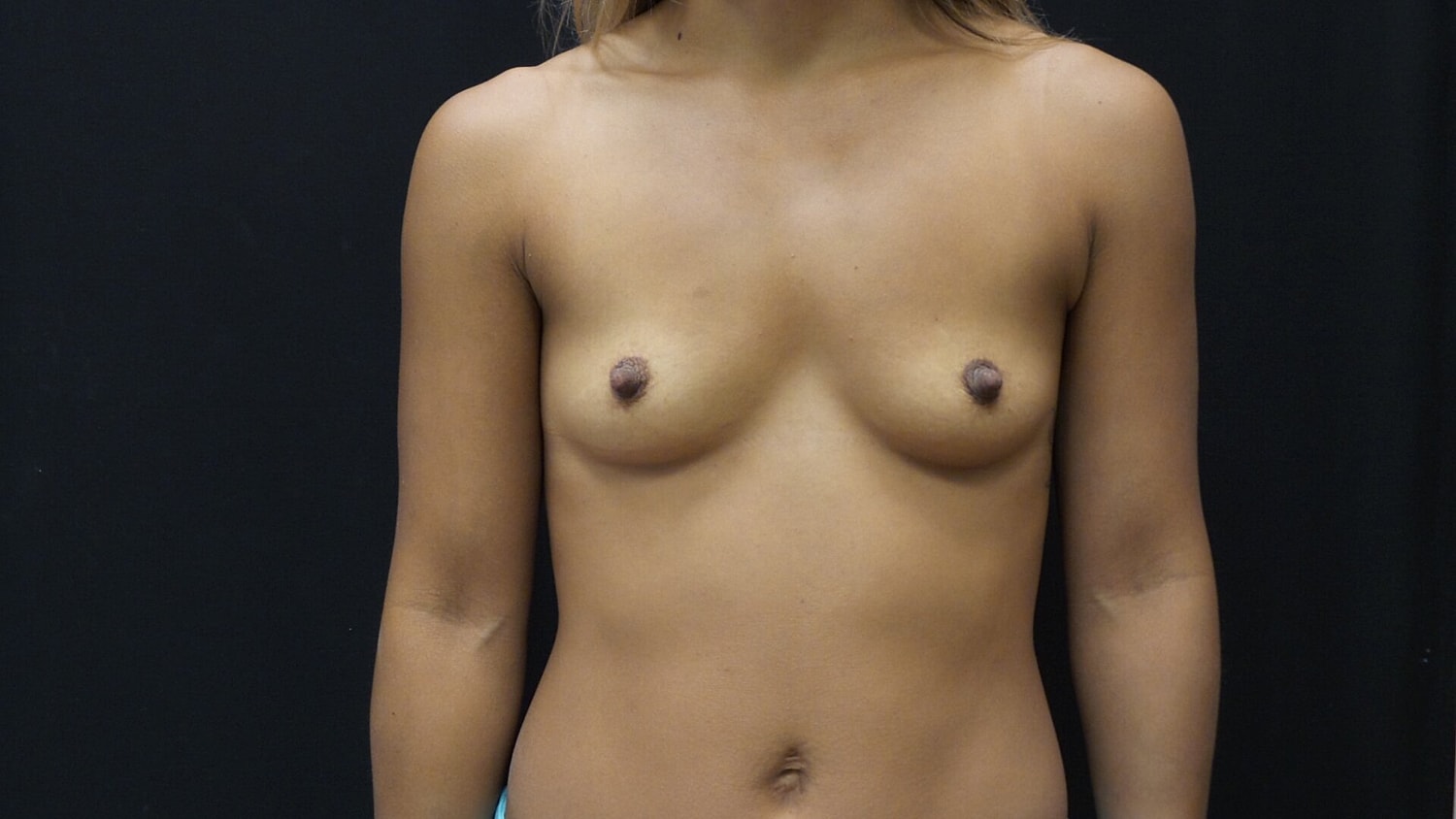 Breast Augmentation Before & After