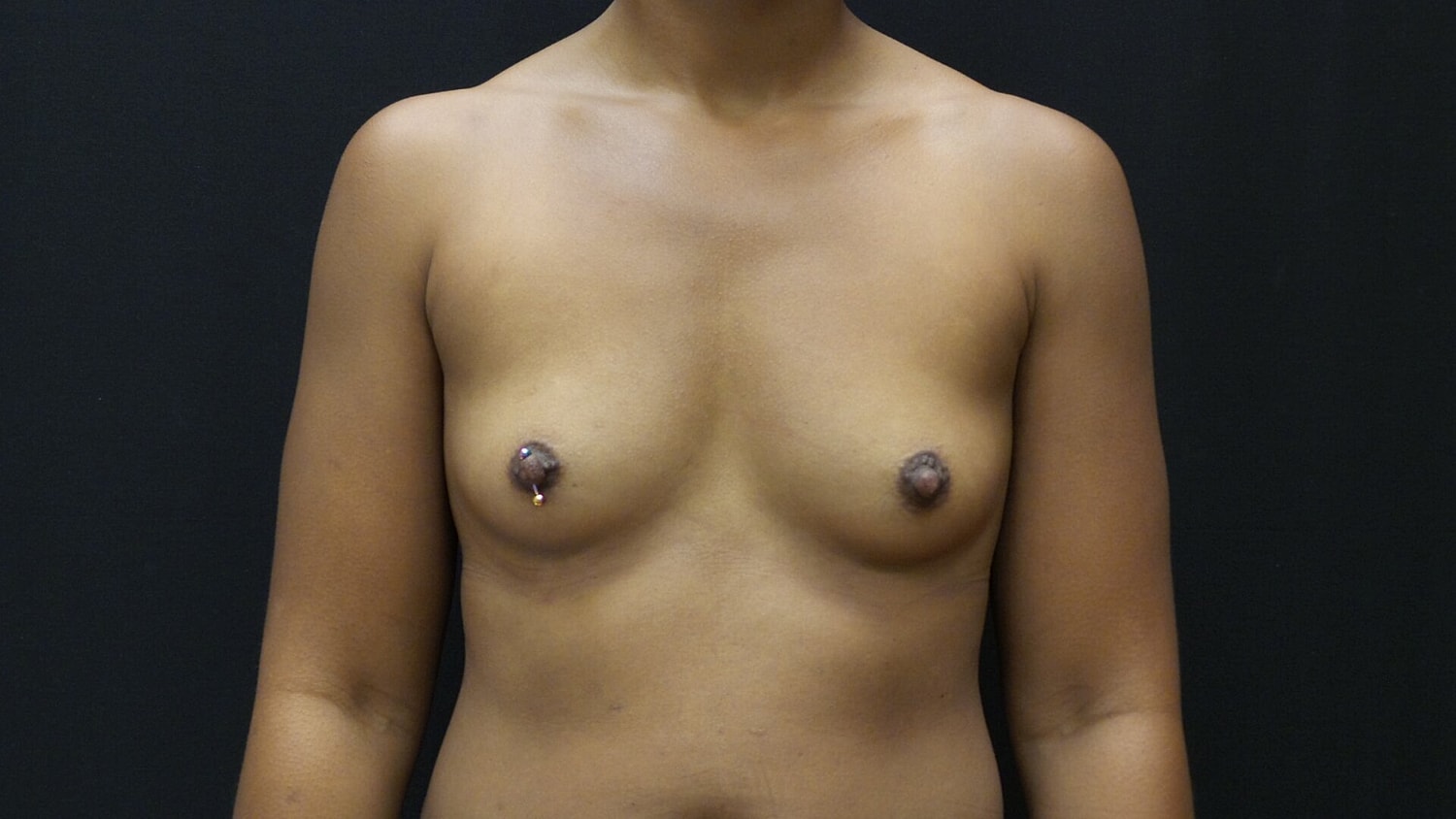 Breast Augmentation Before & After