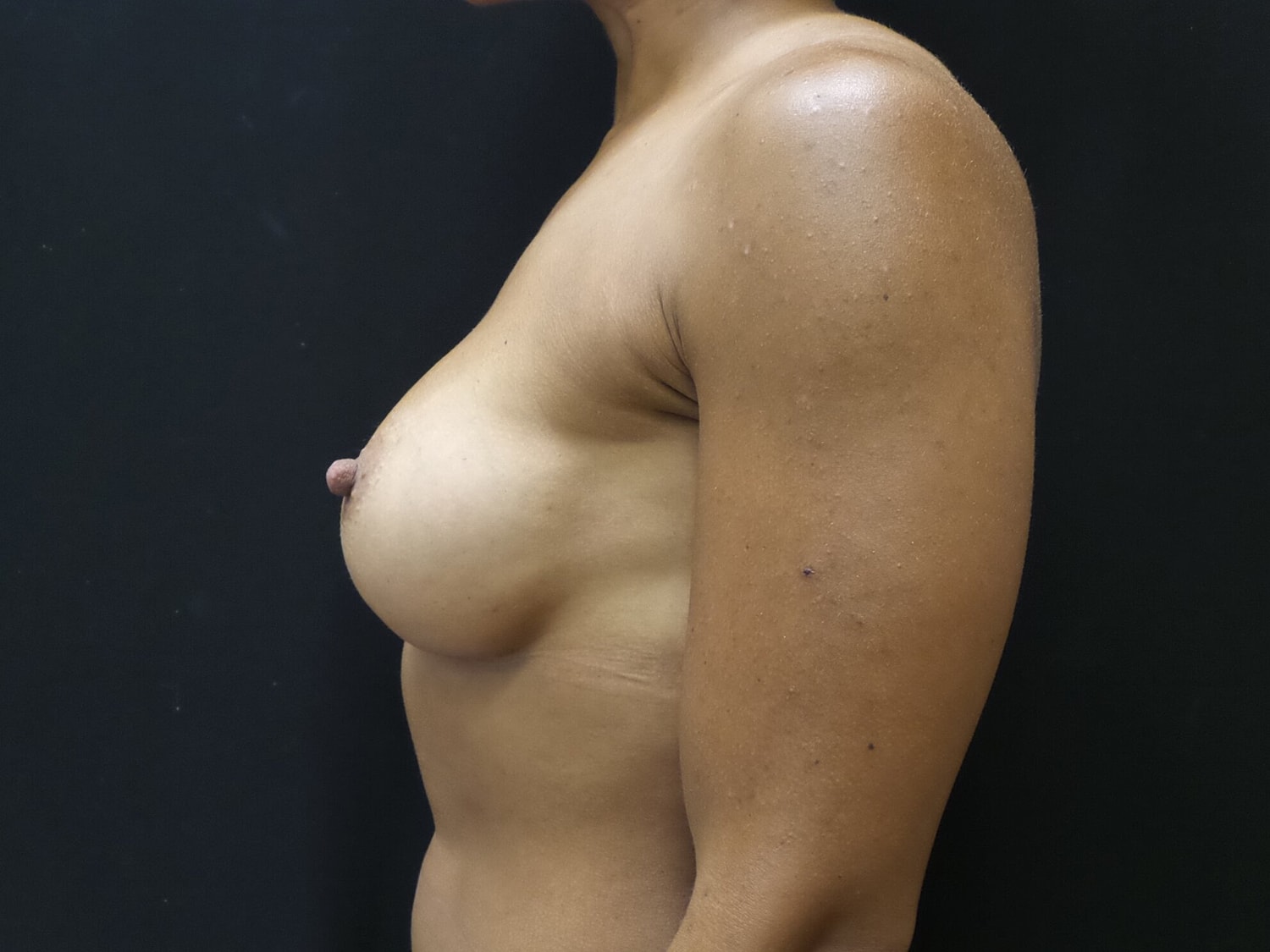 Breast Augmentation Before & After