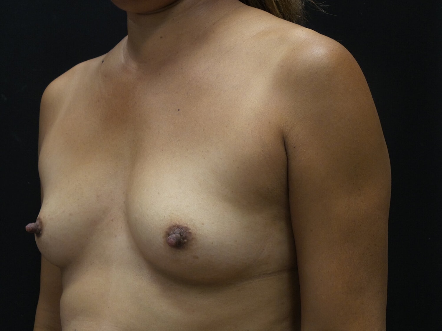 Breast Augmentation Before & After