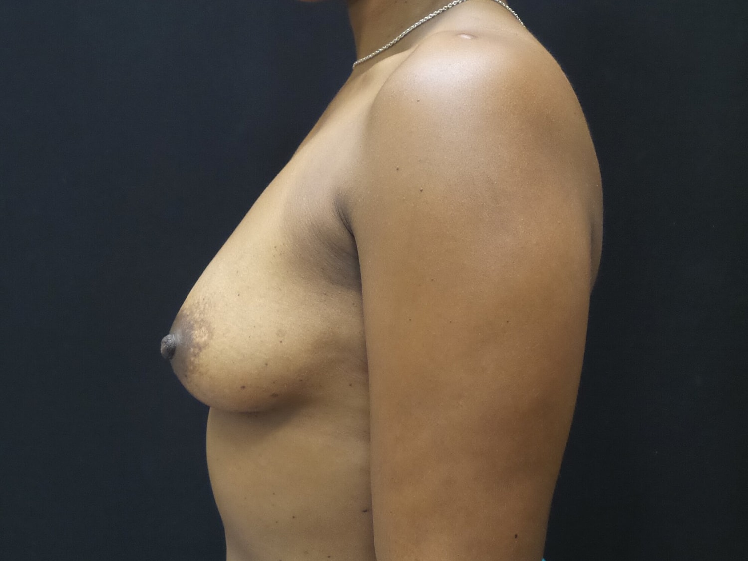Breast Augmentation Before & After