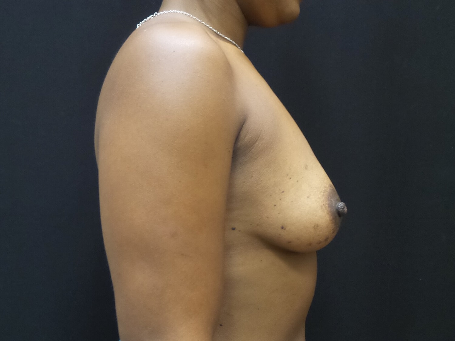 Breast Augmentation Before & After