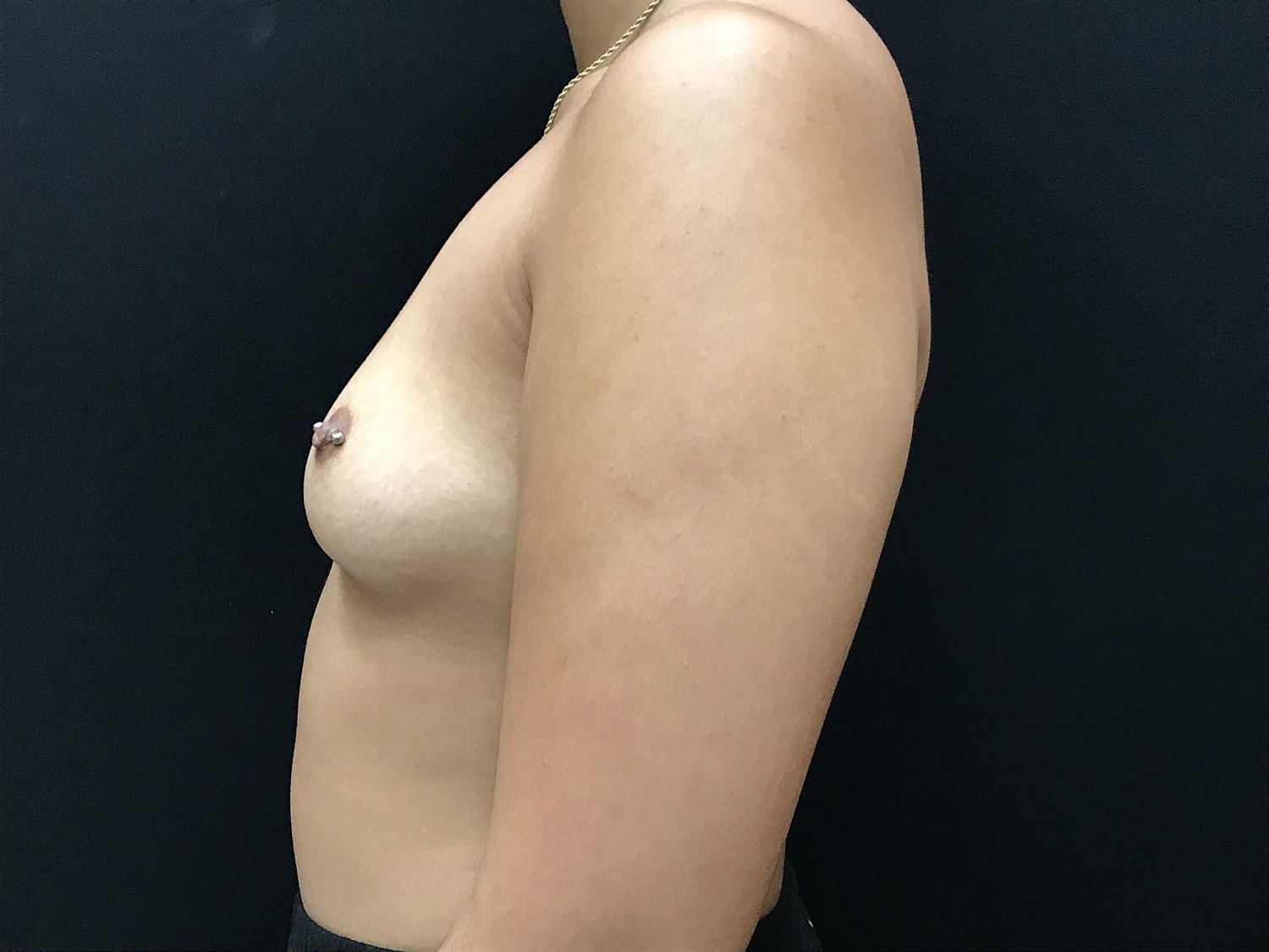 Breast Augmentation Before & After