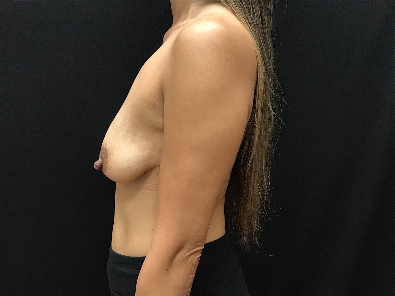 Breast Augmentation Before & After