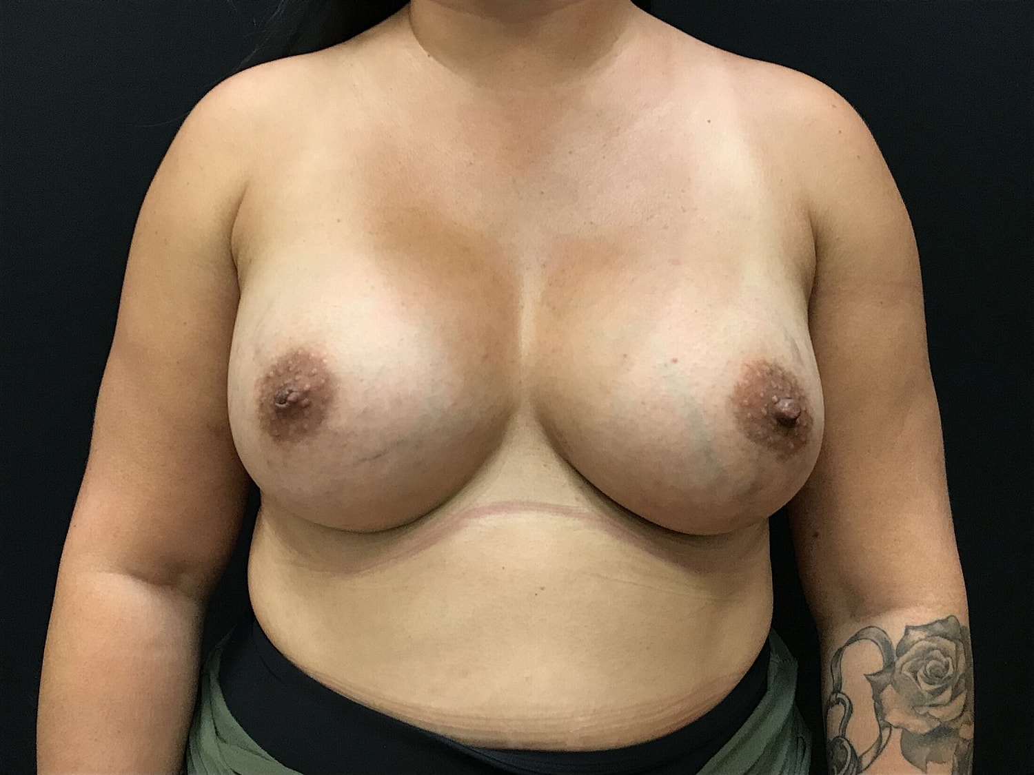 Breast Augmentation Before & After