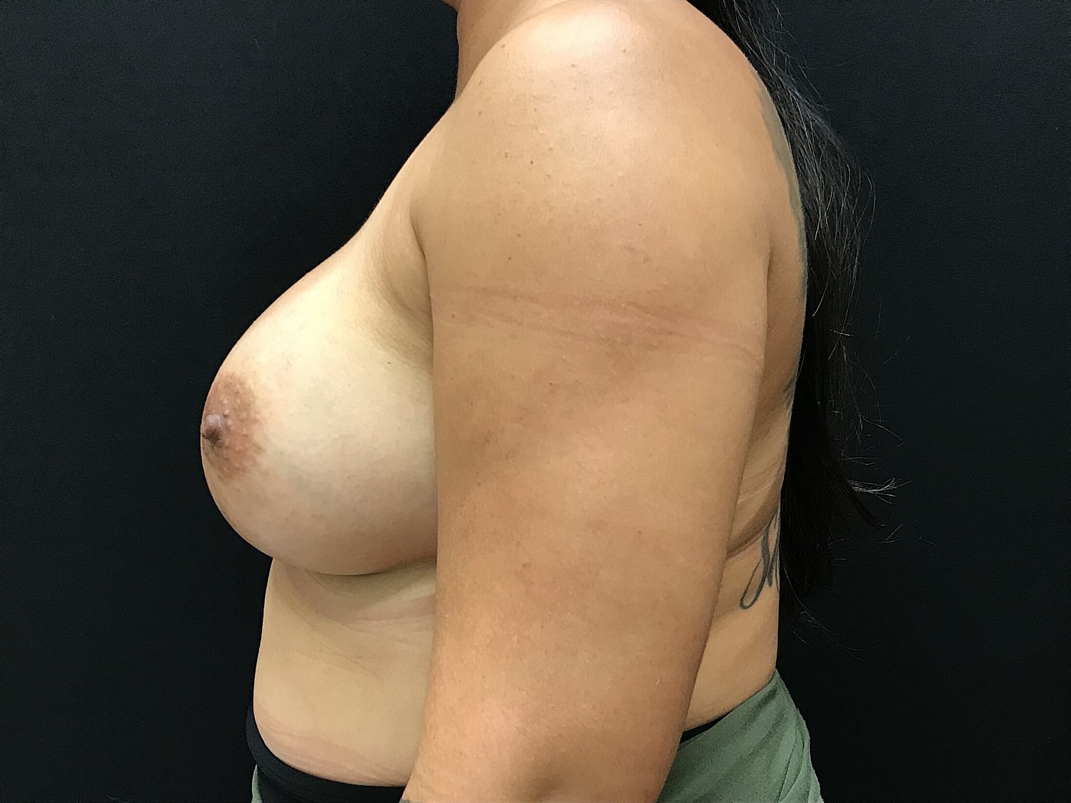 Breast Augmentation Before & After