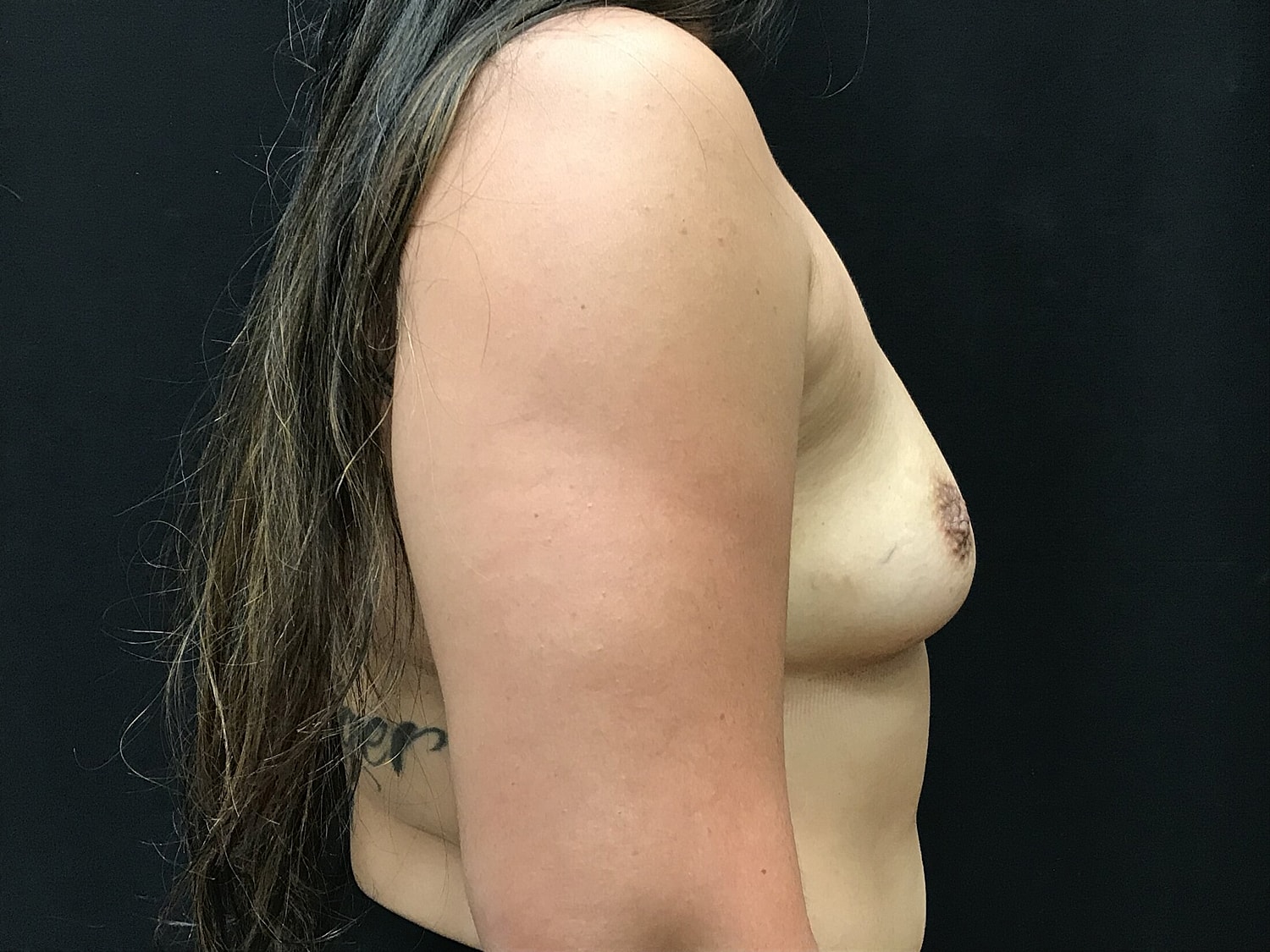 Breast Augmentation Before & After