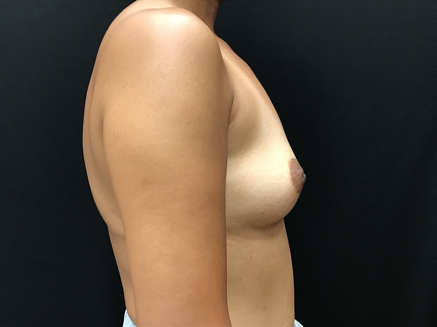 Breast Augmentation Before & After
