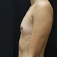 Breast Augmentation Before & After