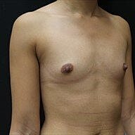 Breast Augmentation Before & After