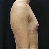 Breast Augmentation Before & After