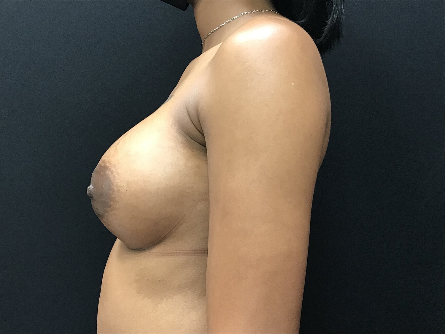 Breast Augmentation Before & After