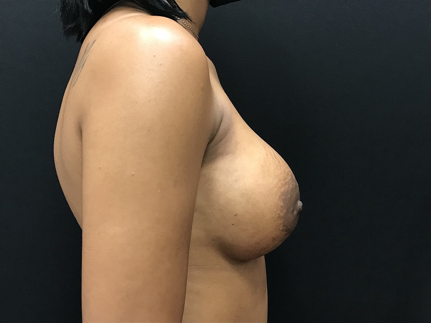 Breast Augmentation Before & After