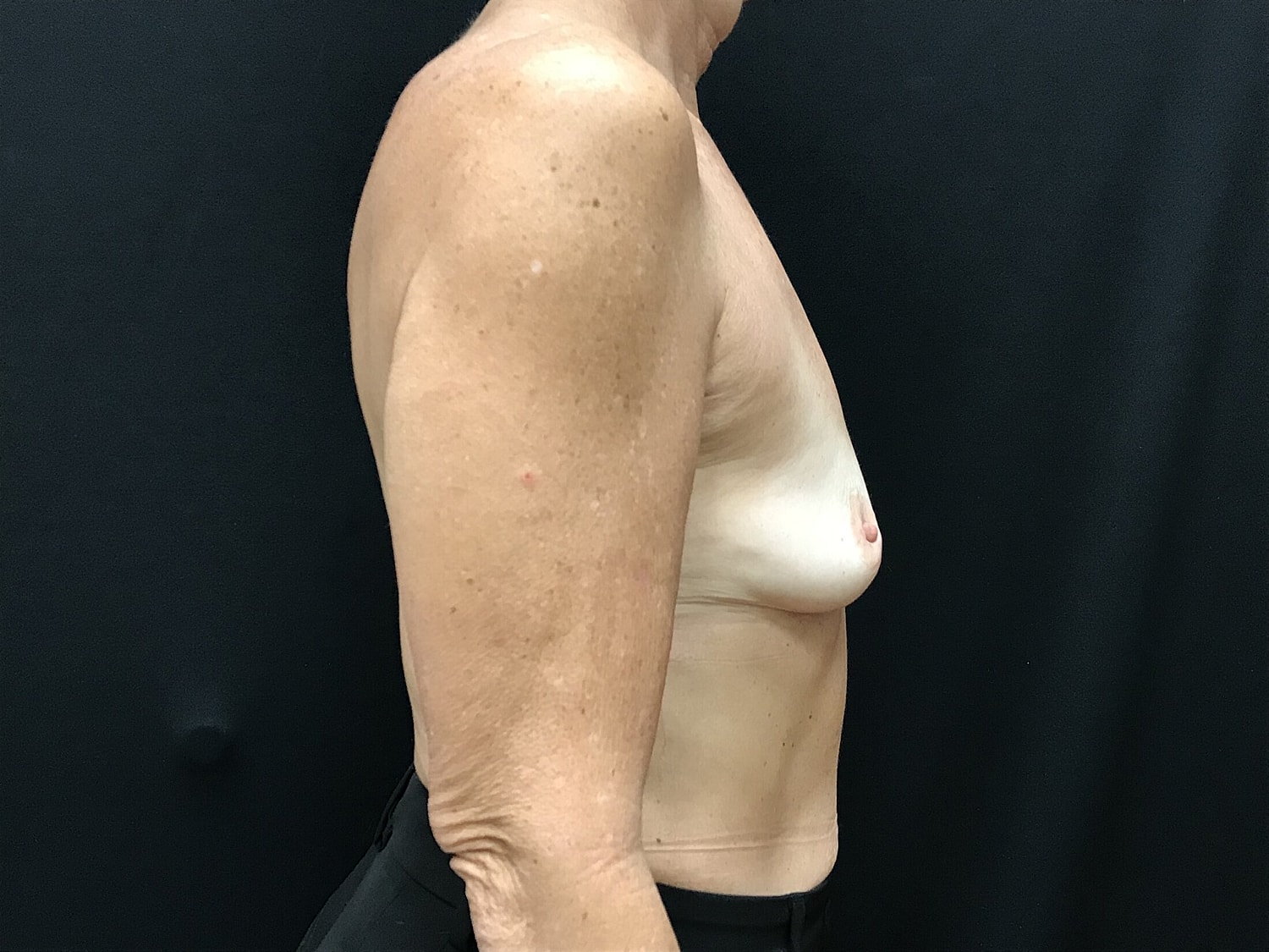 Breast Augmentation Before & After