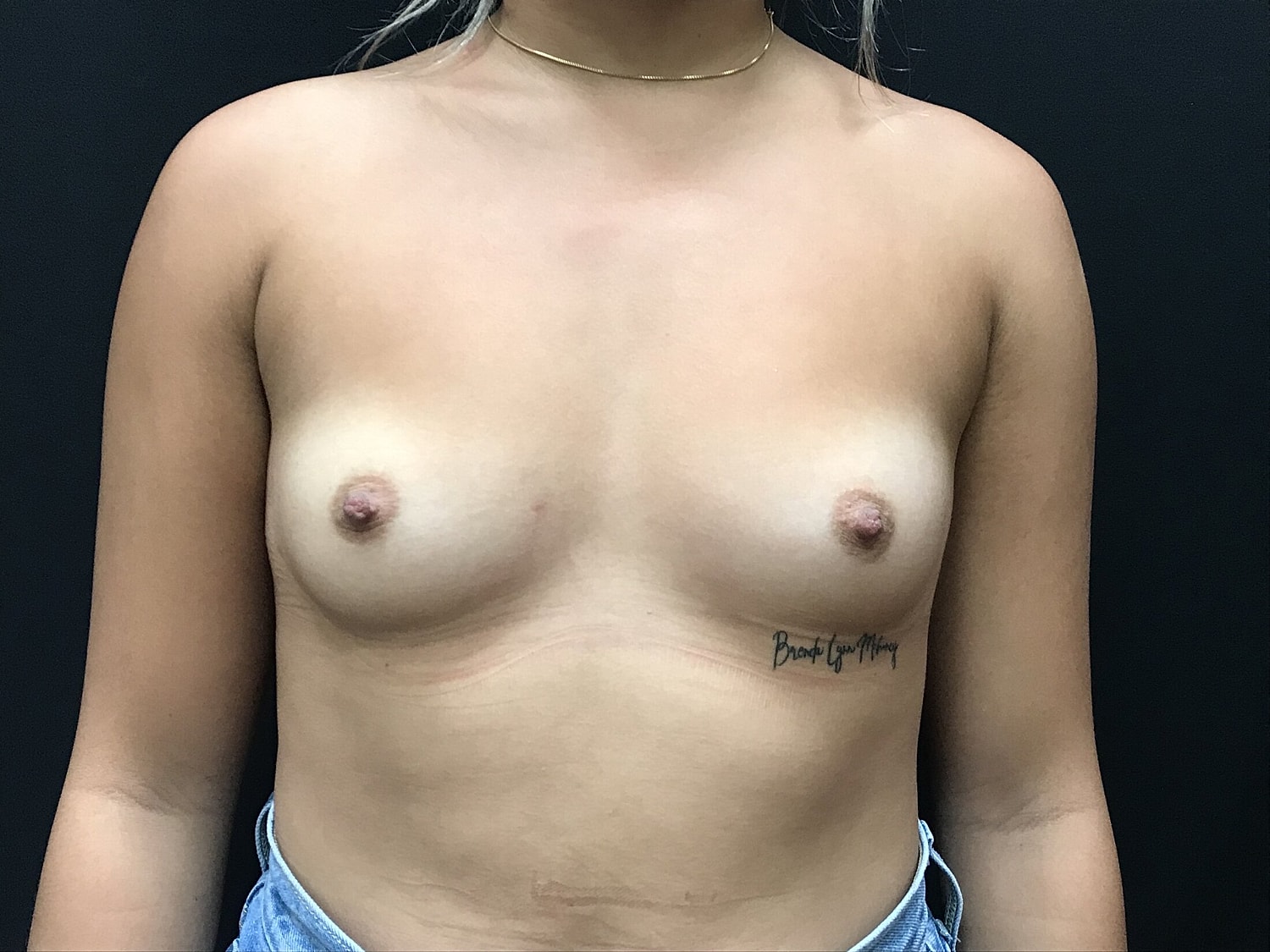 Breast Augmentation Before & After