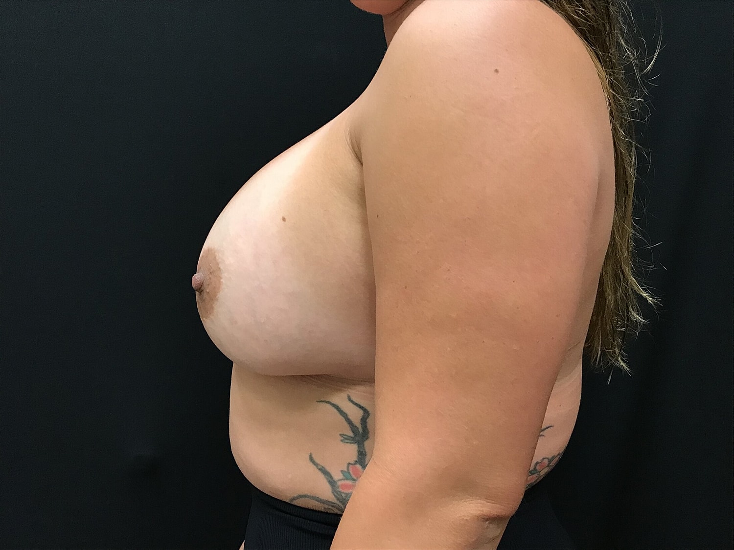 Breast Augmentation Before & After