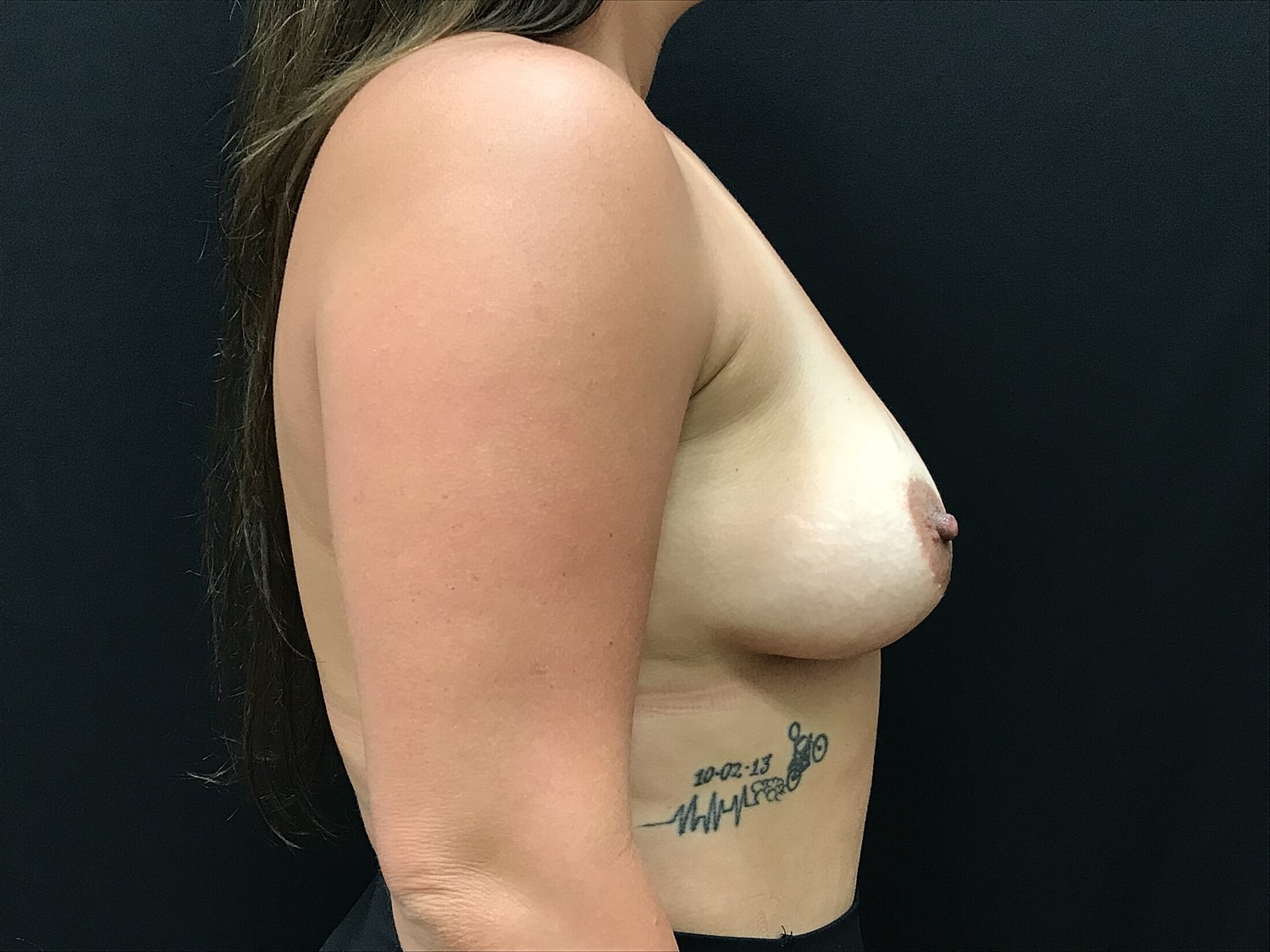 Breast Augmentation Before & After