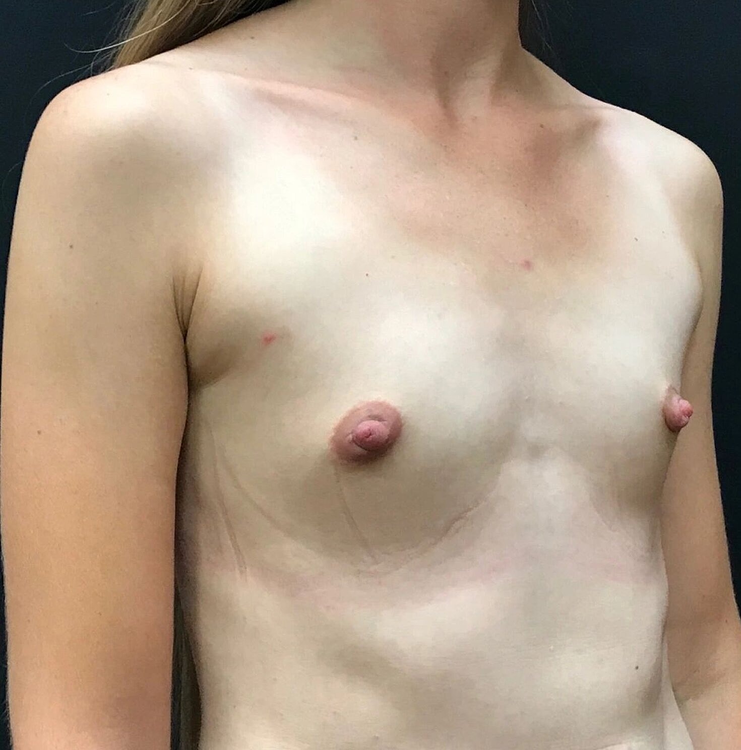 Breast Augmentation Before & After