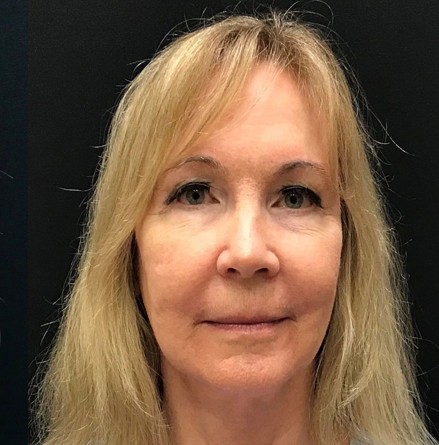 Facelift Before & After