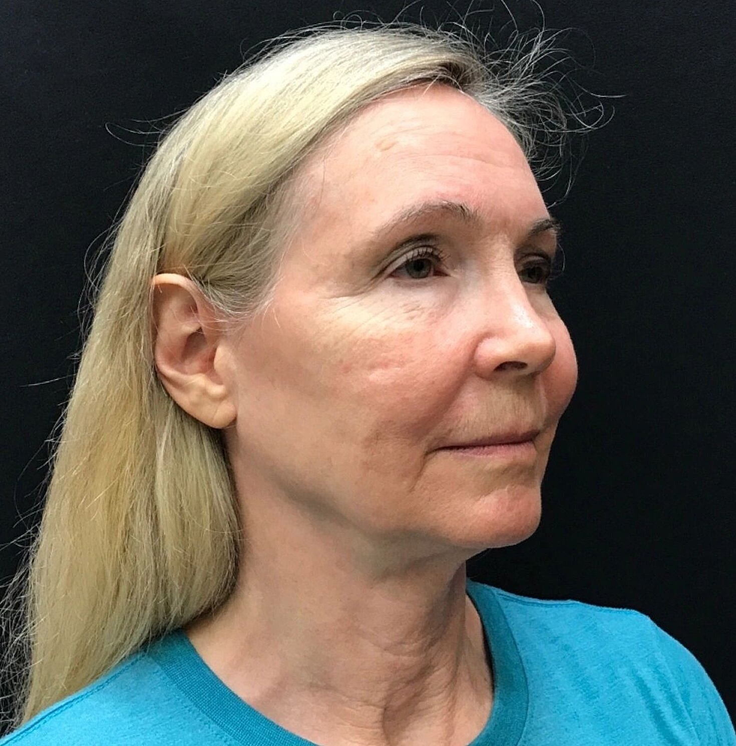 Facelift Before & After