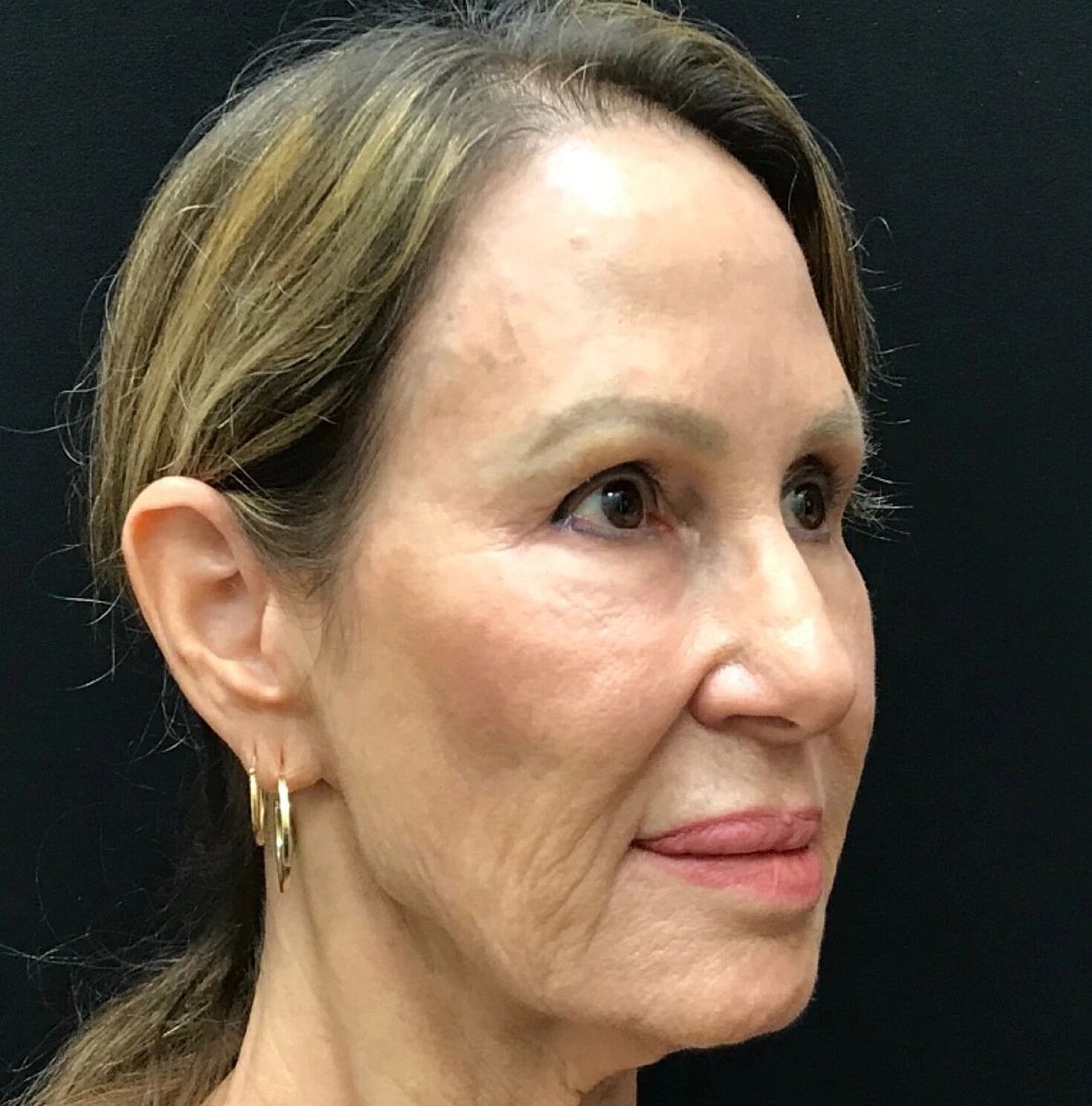 Facelift Before & After