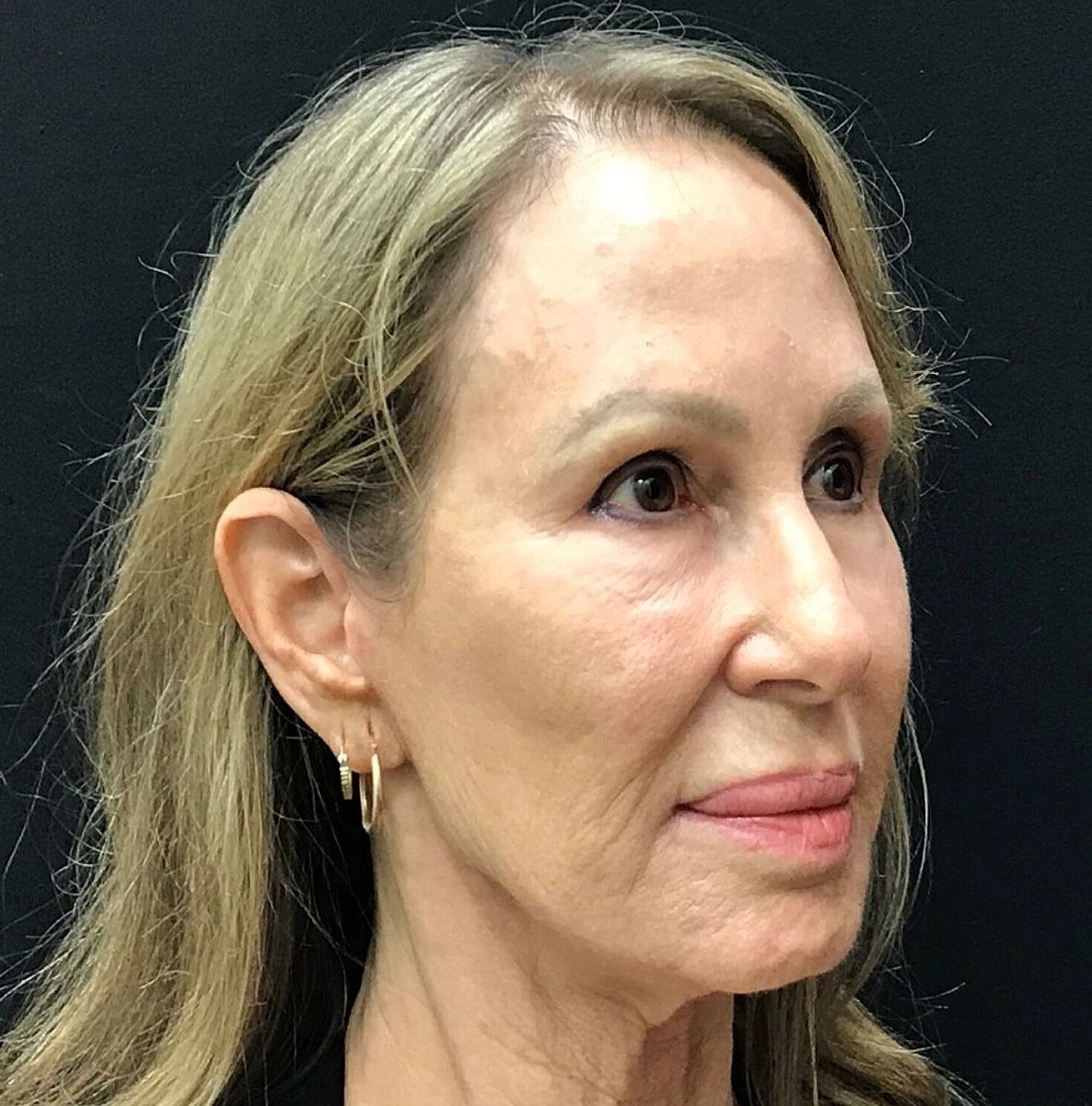 Facelift Before & After