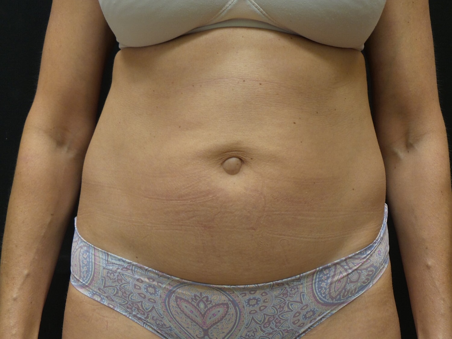 Tummy Tuck Before & After