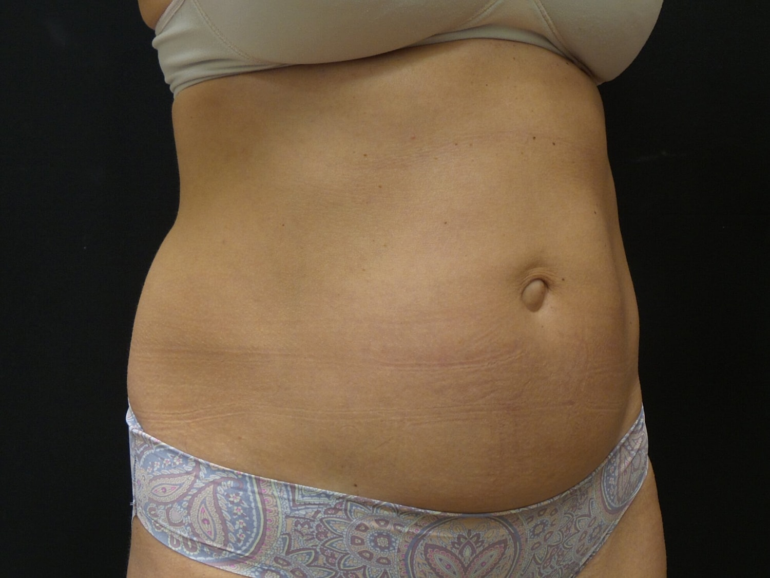 Tummy Tuck Before & After