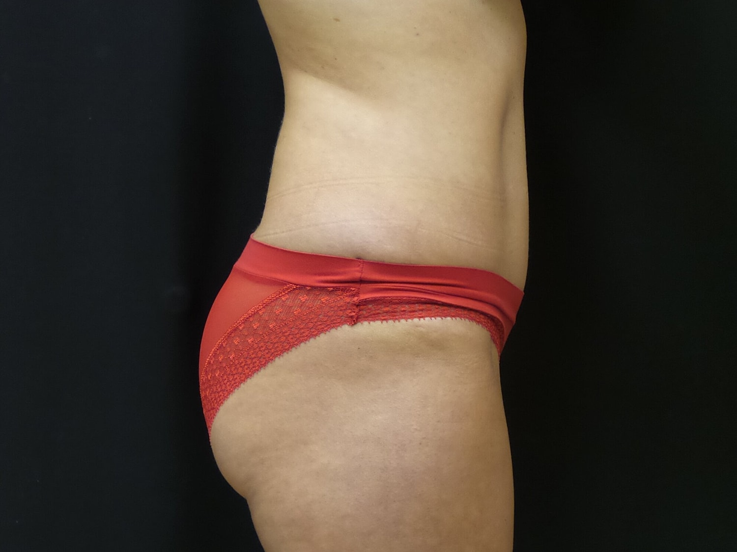 Tummy Tuck Before & After