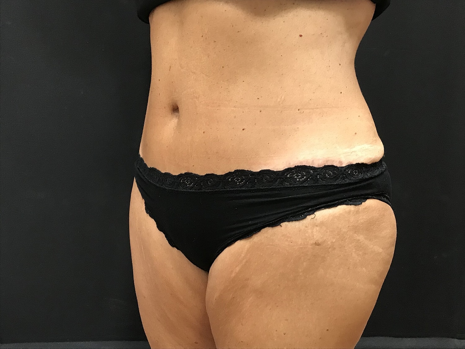 Tummy Tuck Before & After