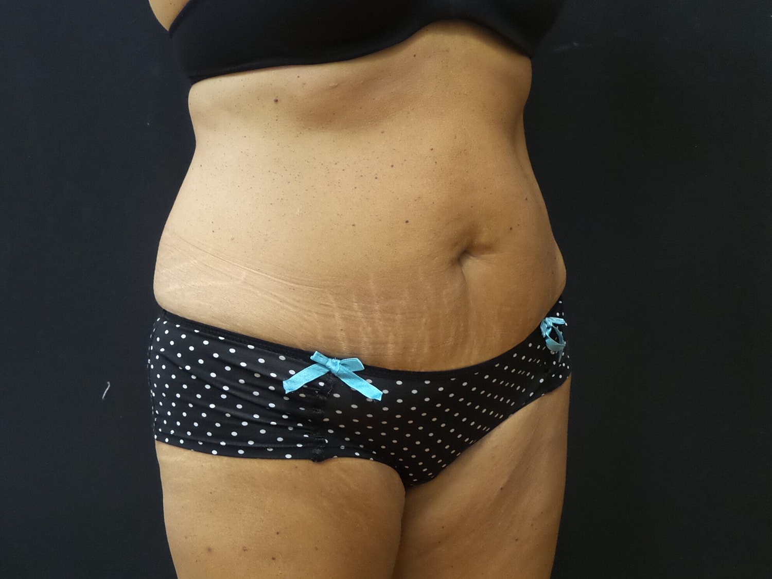 Tummy Tuck Before & After