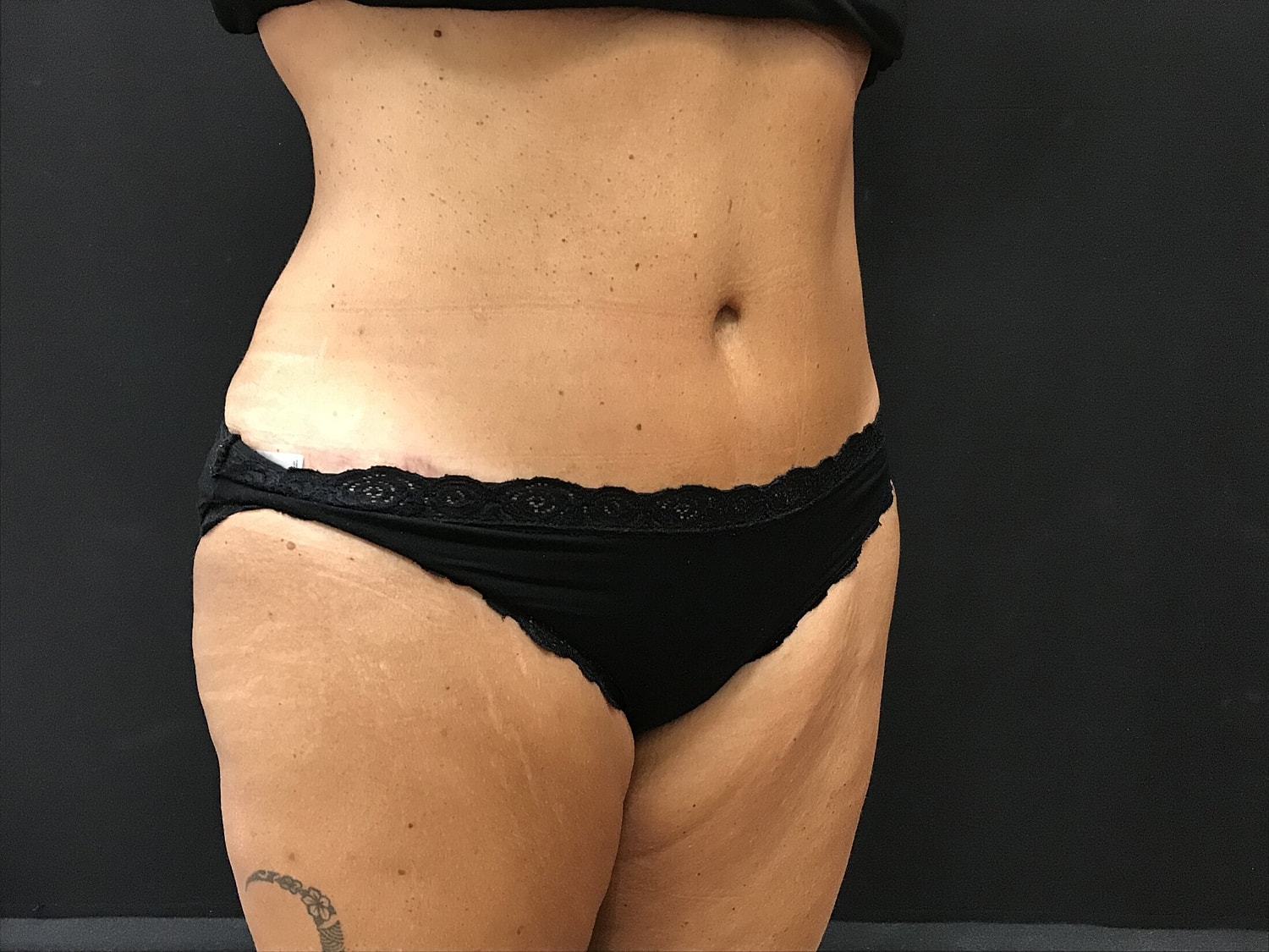 Tummy Tuck Before & After