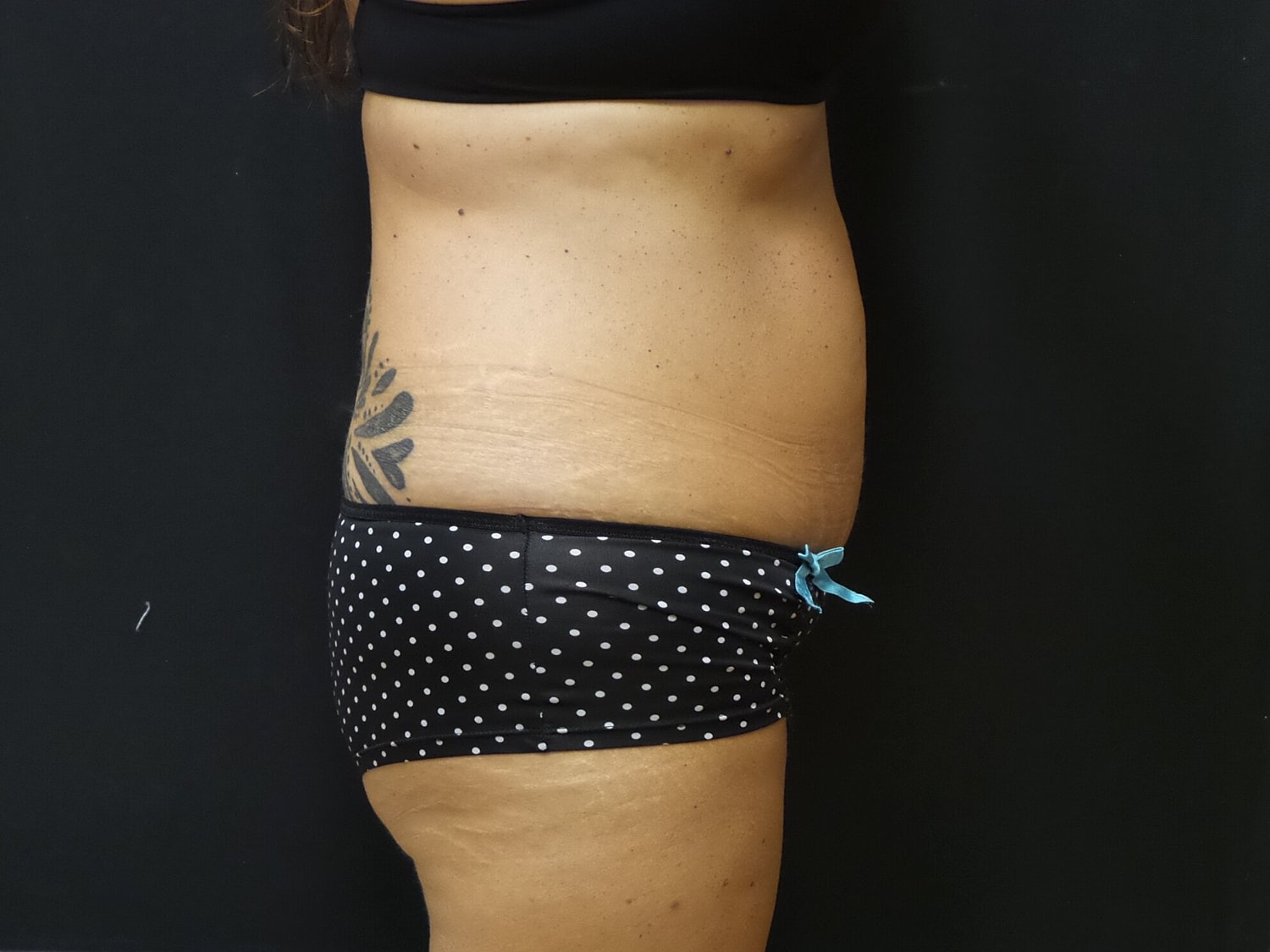 Tummy Tuck Before & After