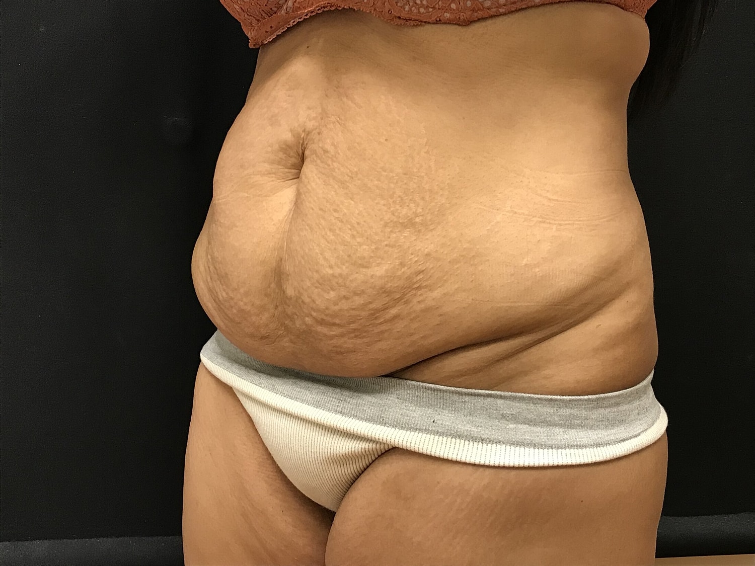 Tummy Tuck Before & After