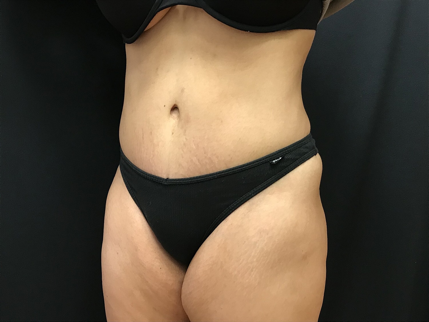 Tummy Tuck Before & After