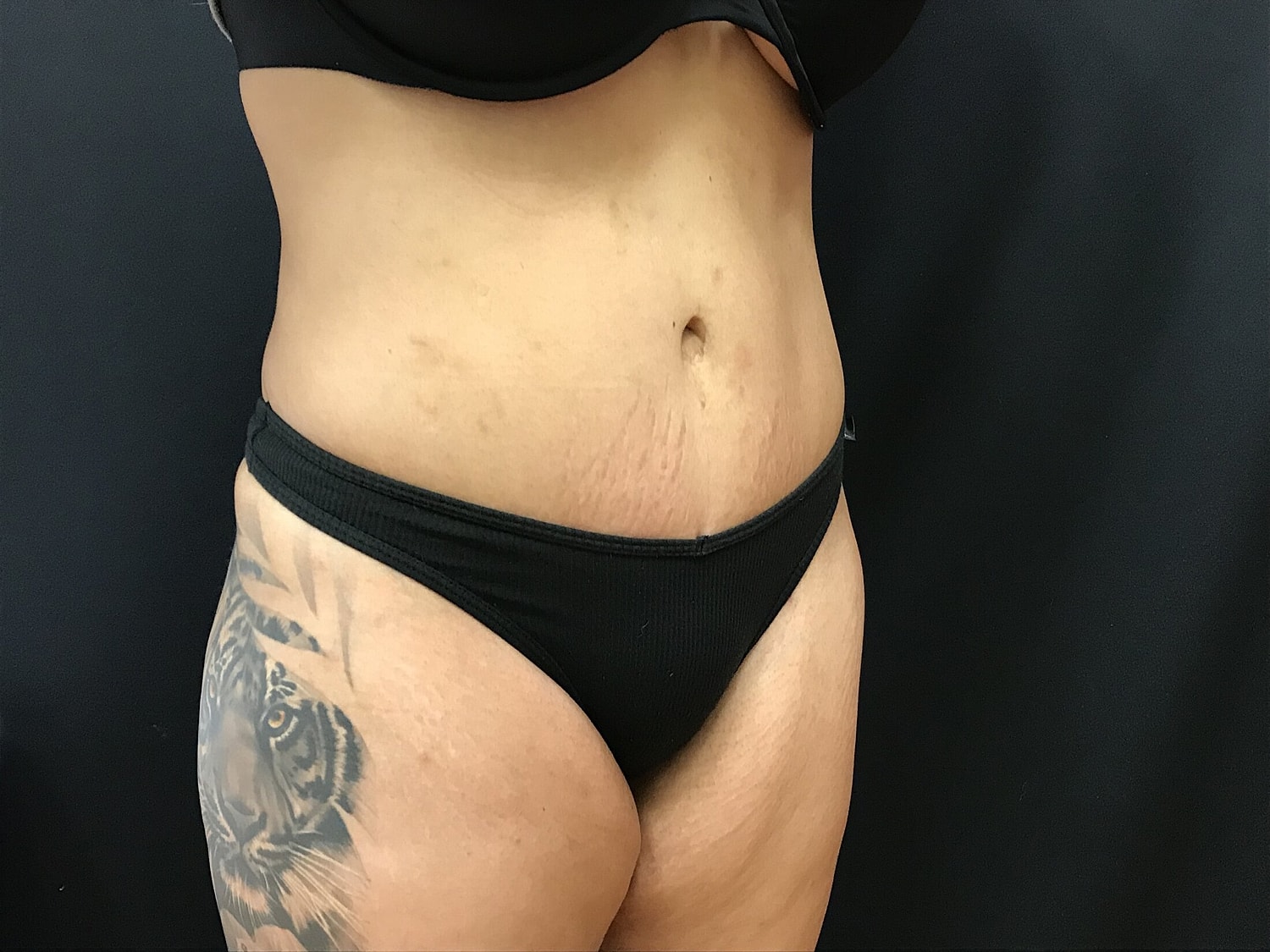 Tummy Tuck Before & After