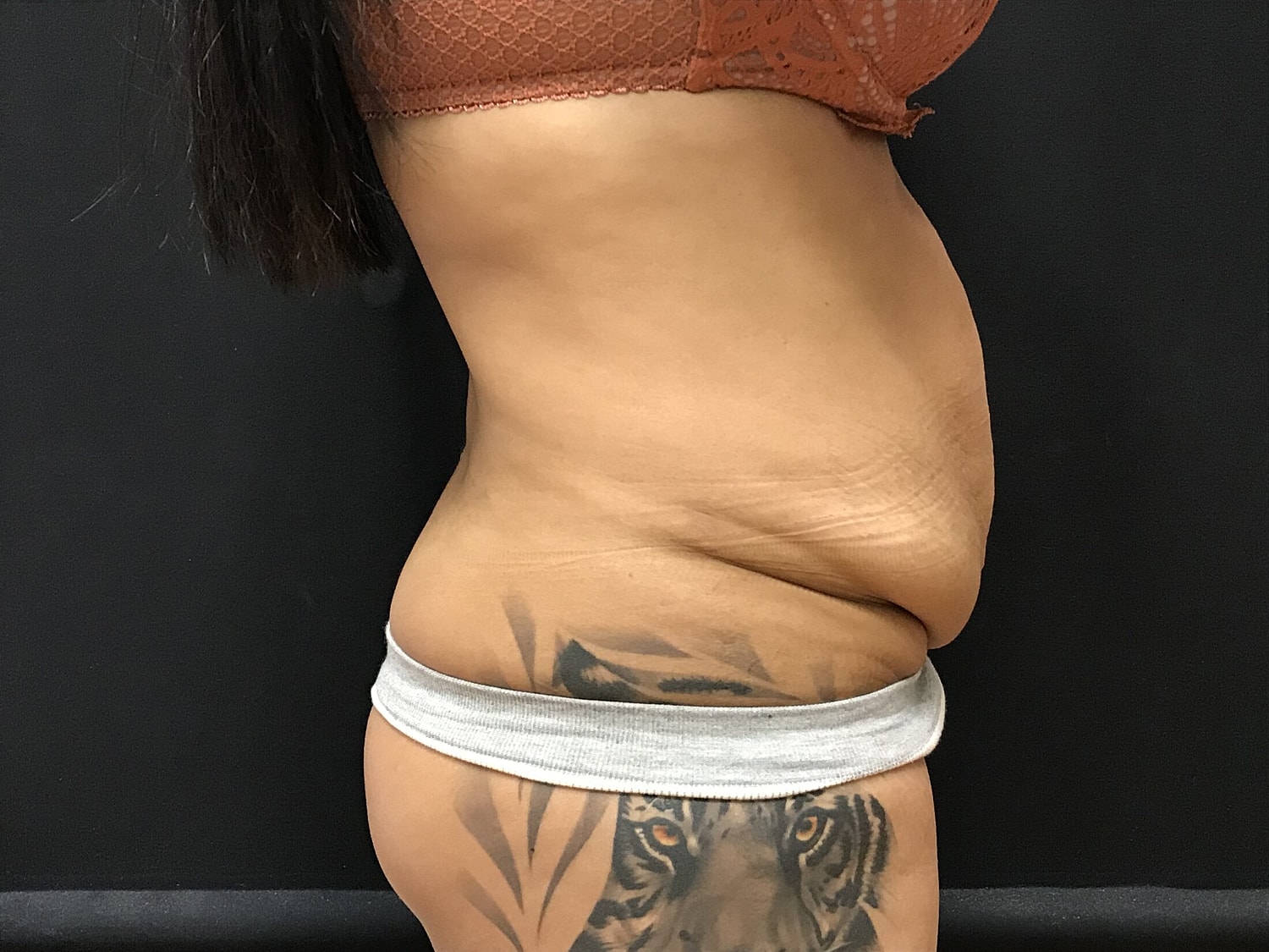 Tummy Tuck Before & After