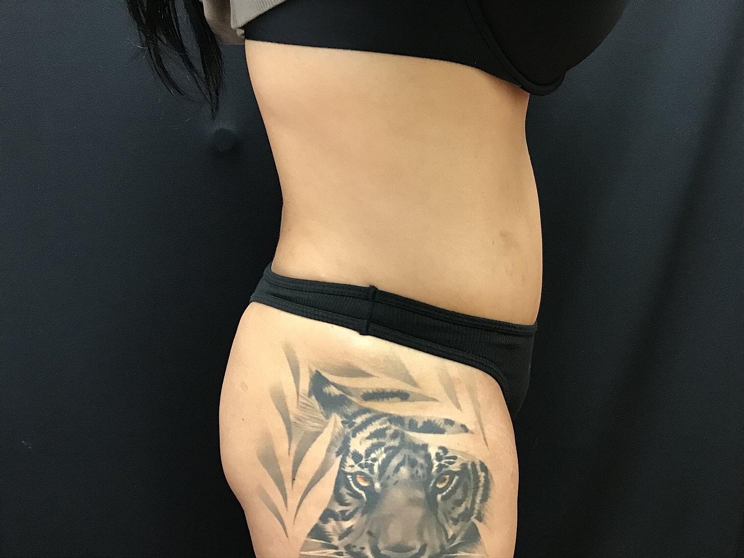 Tummy Tuck Before & After