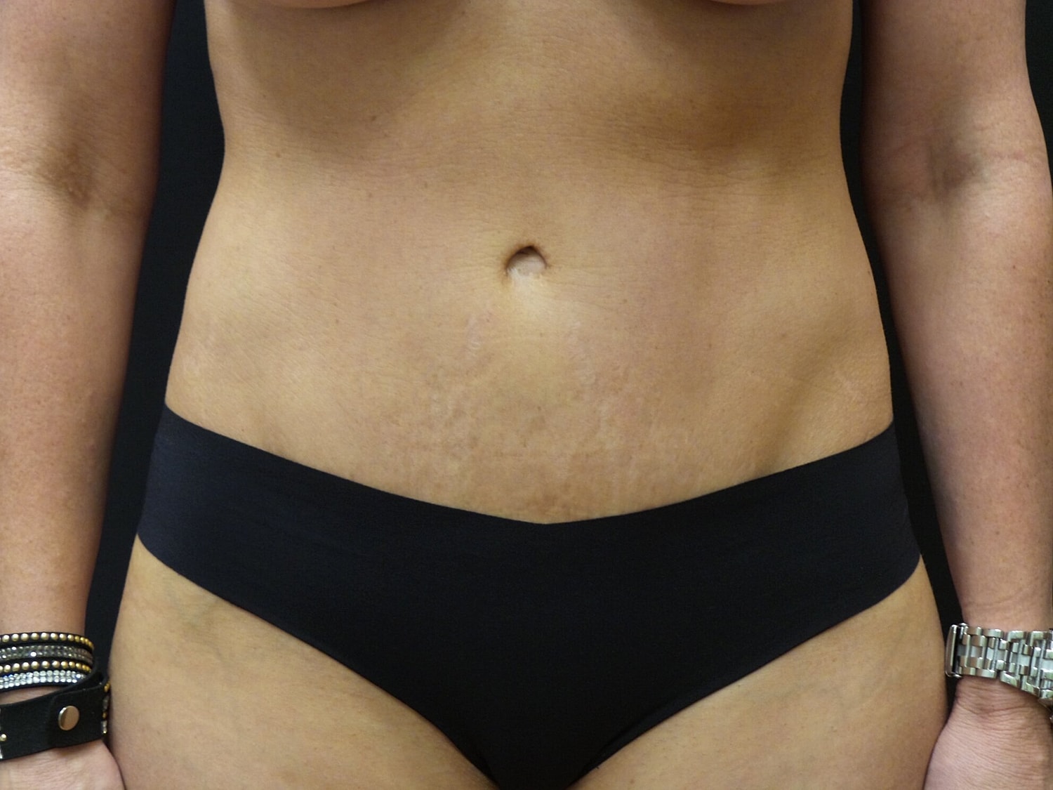 Tummy Tuck Before & After