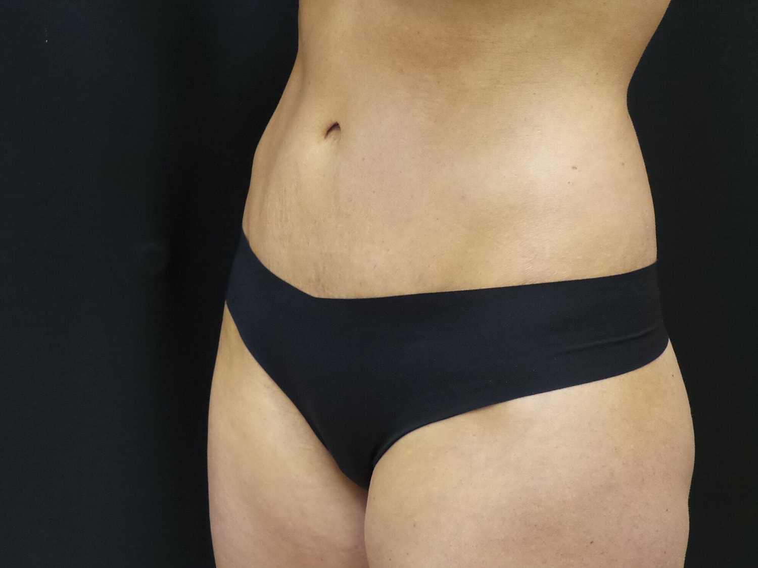 Tummy Tuck Before & After