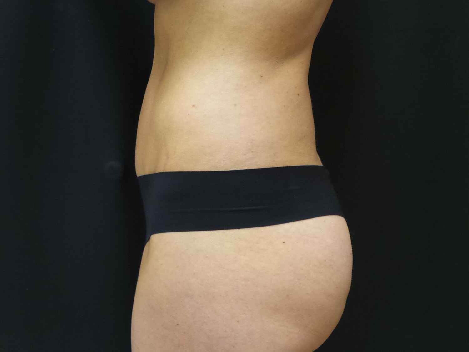 Tummy Tuck Before & After